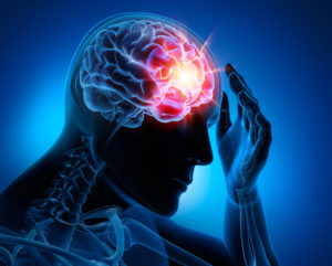 How Long Do I Have to File a Brain Injury Lawsuit in Florida?