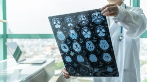 What are the Signs and Symptoms of Brain Injuries?